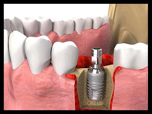 IMPLANT TREATMENT